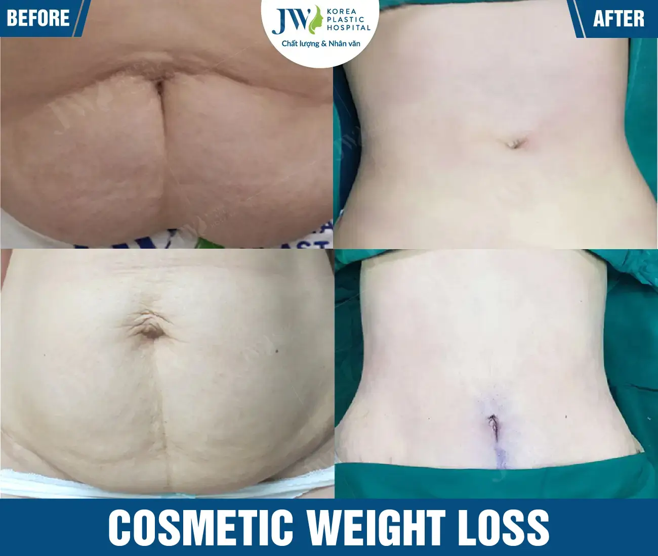 Cosmetic weight loss